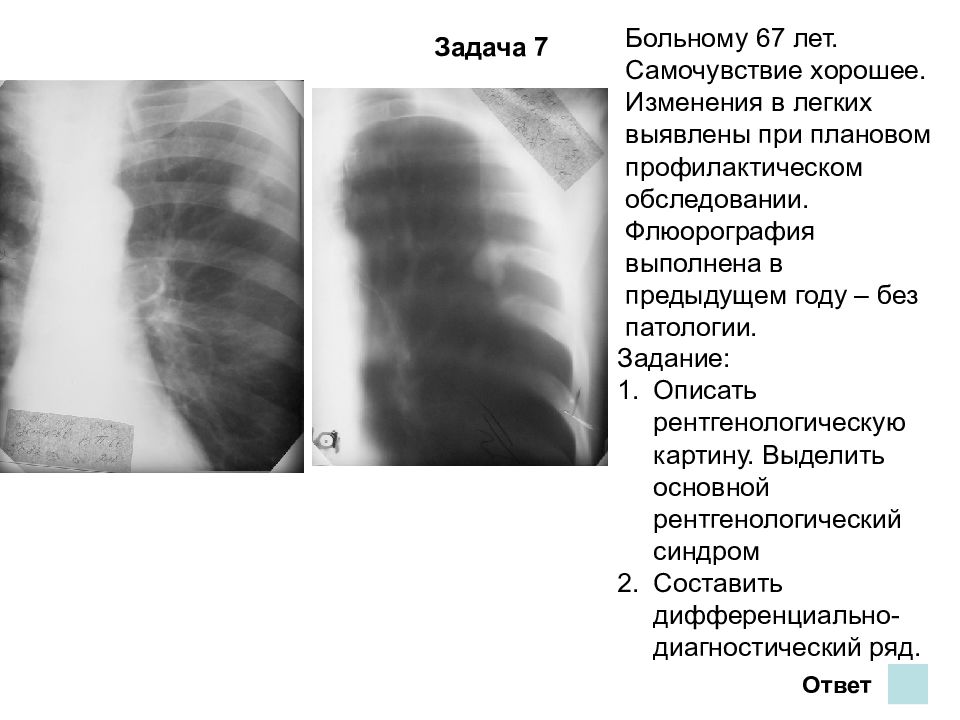 Изменение легочного рисунка на флюорографии что это значит