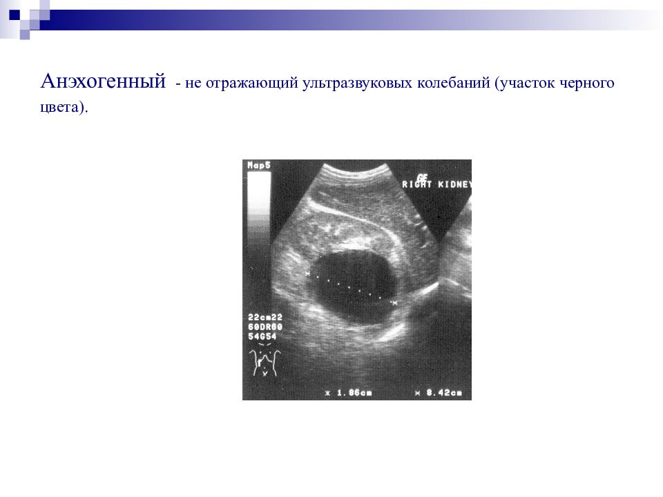 Анэхогенное образование. Анэхогенная структура УЗИ. На УЗИ анэхогенная зона. Анэхогенные включения. Анэхогенный образование.