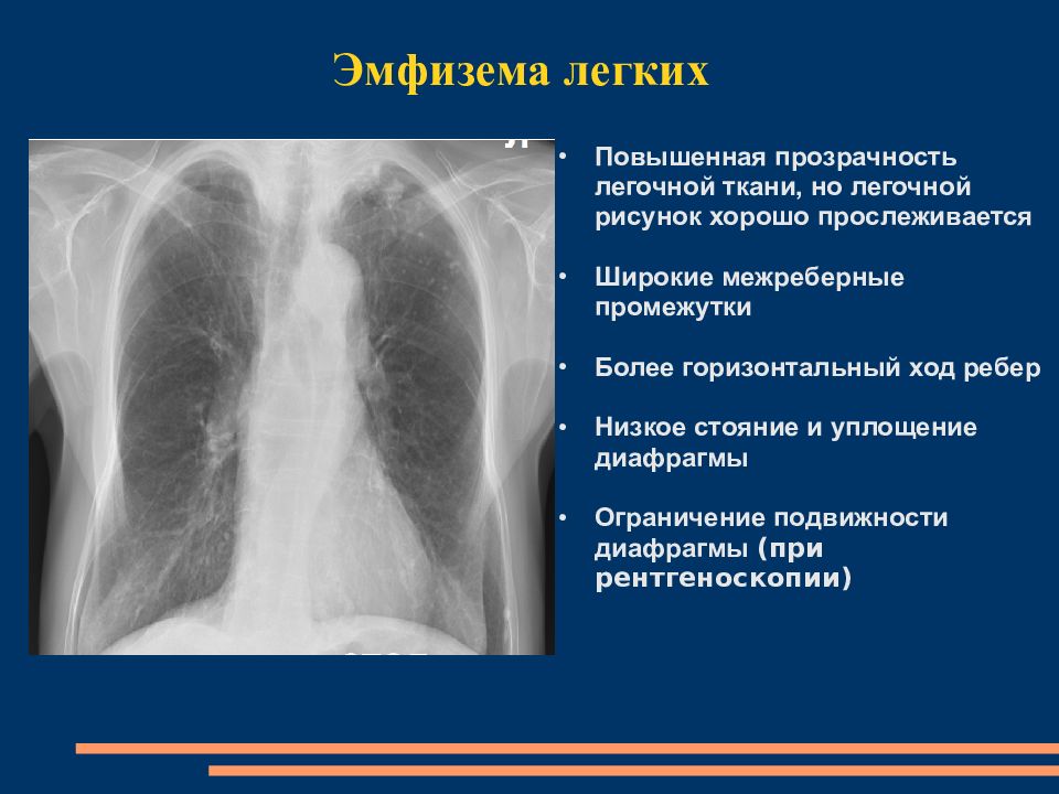 Увеличение легких. Повышение прозрачности легочной ткани. Повышенная прозрачность легких на рентгенограмме. Повышение прозрачности легочной ткани на рентгене. Повышение прозрачности легких на рентгенограмме.