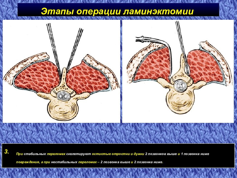 Этапы операции. Операция этапы операции. Спинной мозг ламинэктомия.