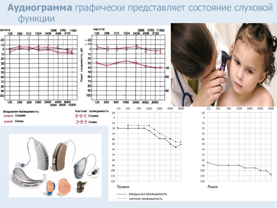 Графическое изображение на специальном бланке данных исследования состояния слуха проводимого с