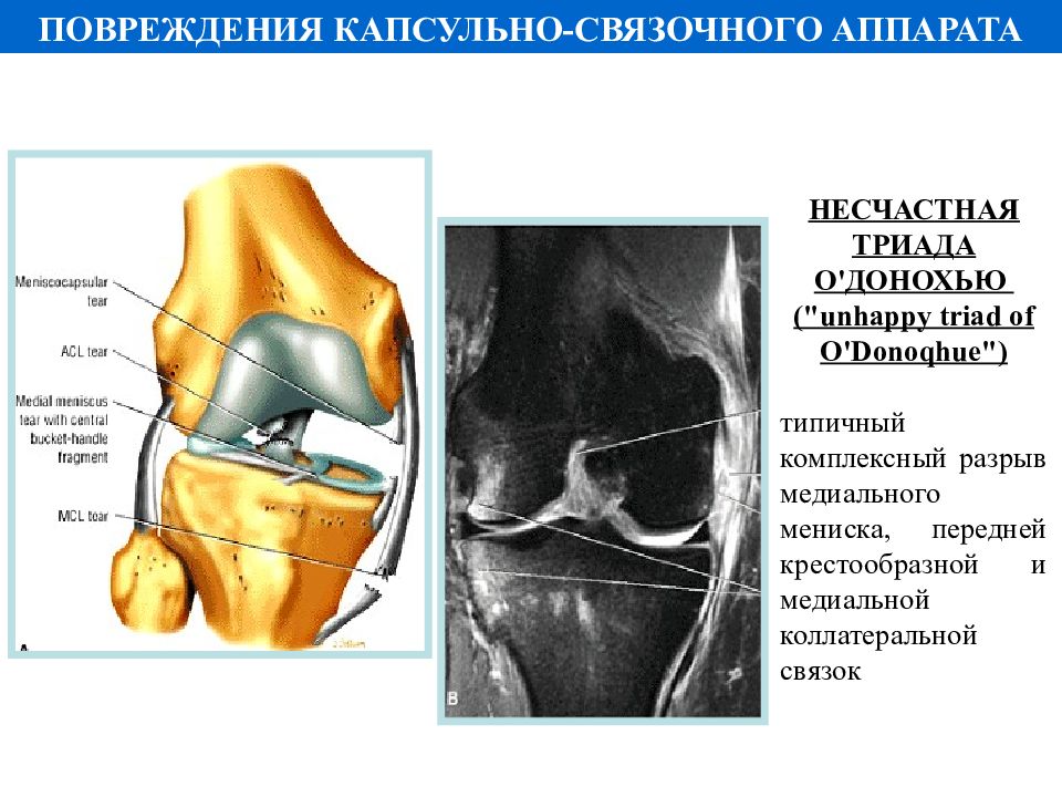 Дисторсия сустава. Травма капсульно-связочного аппарата коленного сустава. Повреждение капсульномвязочногт аппарата. Повреждение капсульно связочного аппарата колена. Капсула связочный аппарат.