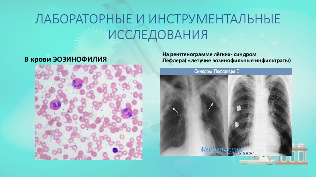 Эозинофилии легких. Синдром Леффлера аскаридоз. Эозинофильный инфильтрат легкого рентген. Аскаридоз рентген легких синдром Леффлера.