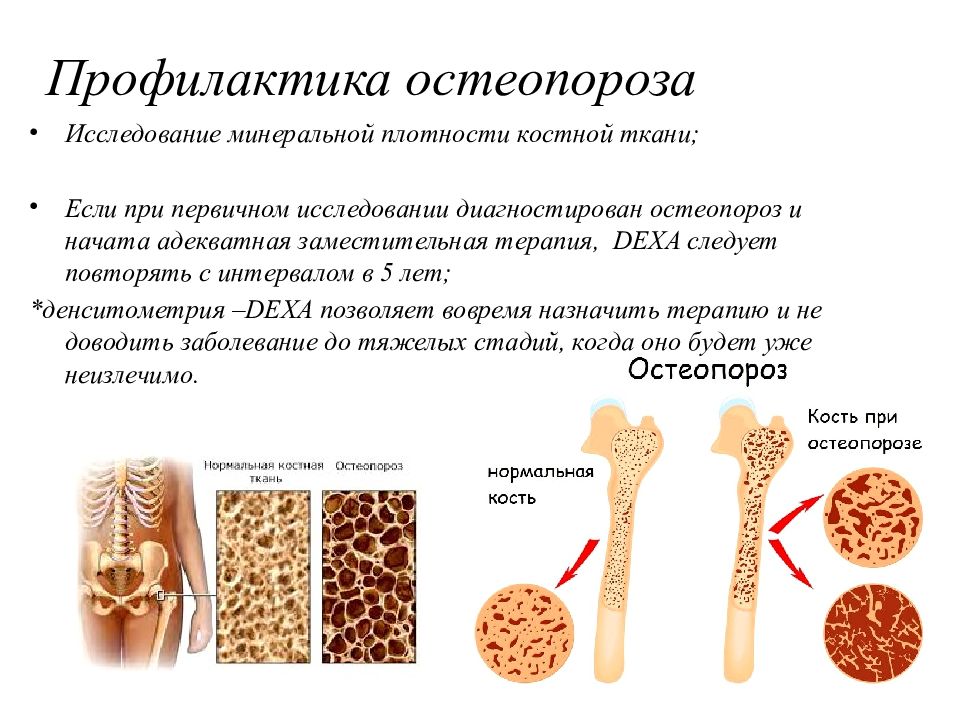 Клиническая картина остеопороза