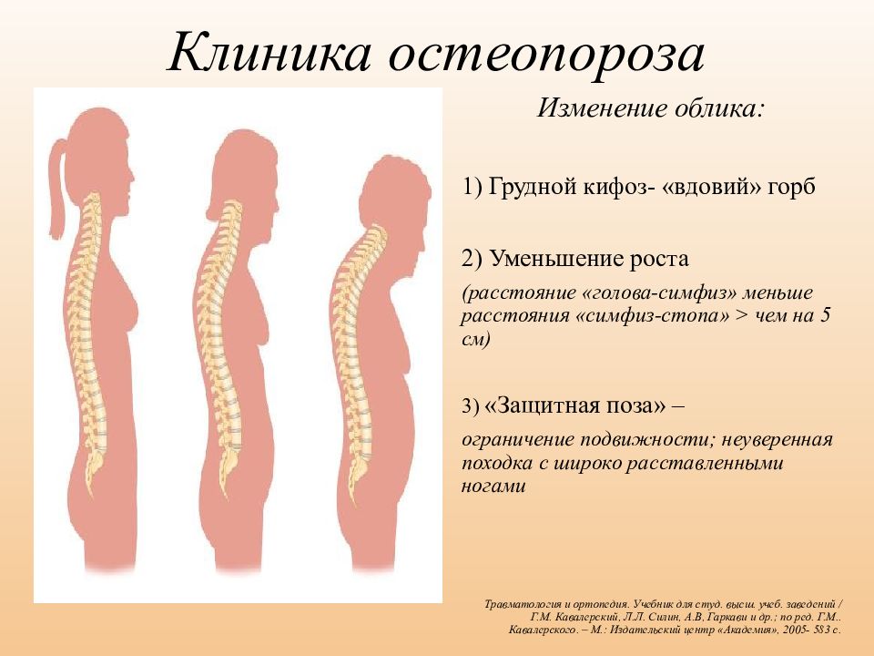 Центр остеопороза. Остеопороз. Клинические проявления остеопороза. Остеопороз клиника. Первичный остеопороз.