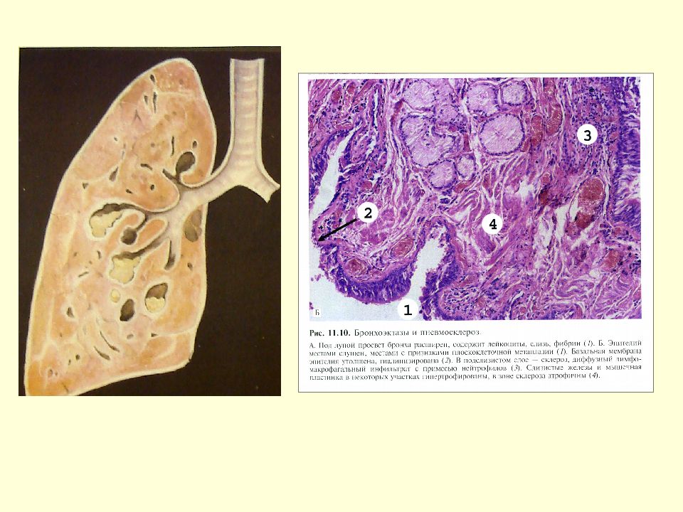 Полость заболевания легких. Хронические болезни легких патанатомия. ХНЗЛ патологическая анатомия. Хронические неспецифические заболевания легких патанатомия. Хронические заболевания легких патологическая анатомия.