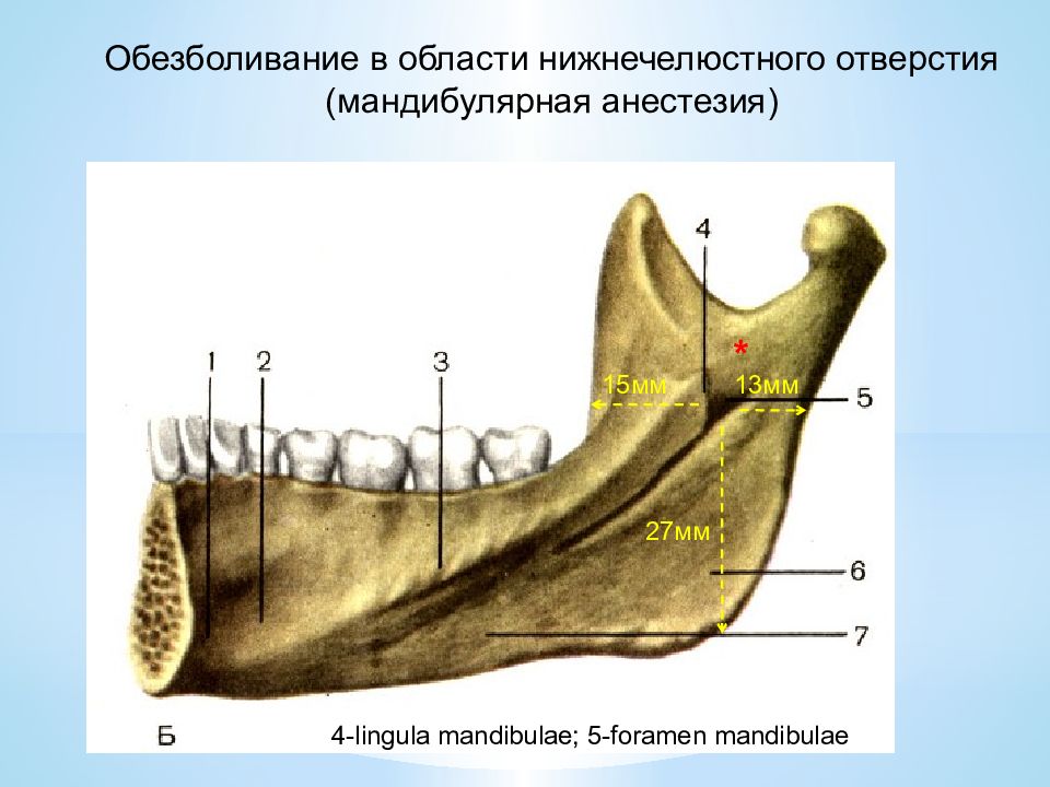 Мандибулярная анестезия презентация