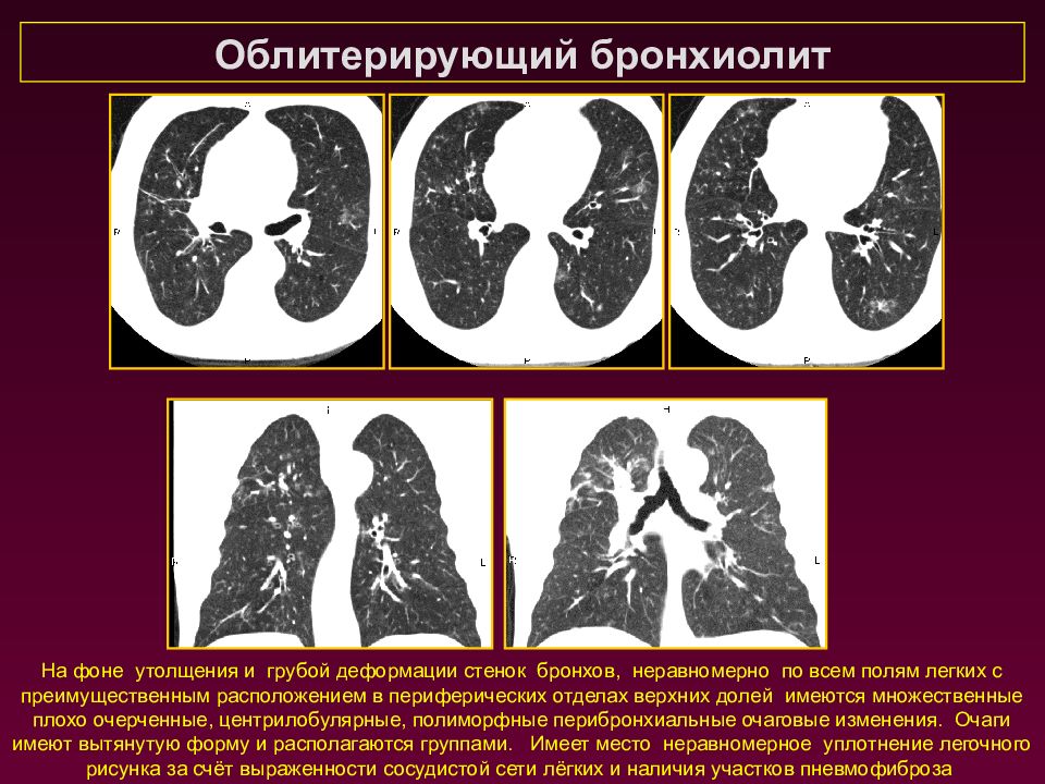 Бронхиолит схема лечения