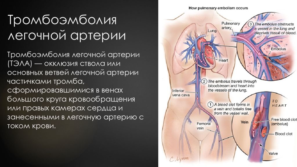 Тромбоэмболия легочной мелких артерий