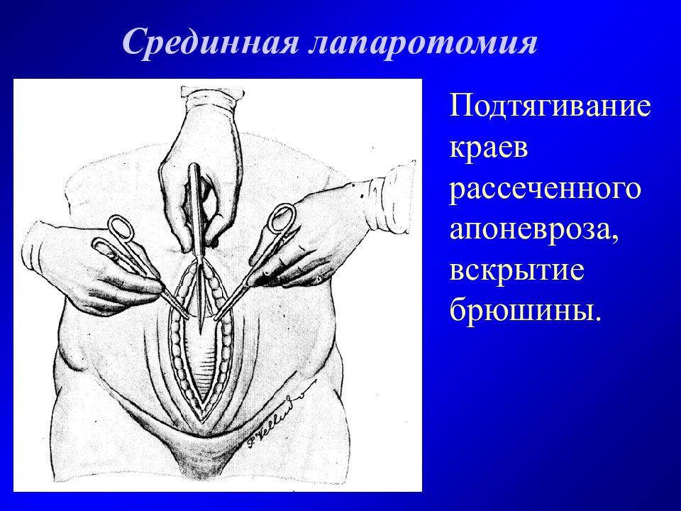 Нижняя лапаротомия. Срединная лапаротомия обход пупка. Субкостальная лапаротомия. Широкая срединная лапаротомия. Верхнесрединная лапаротомия.