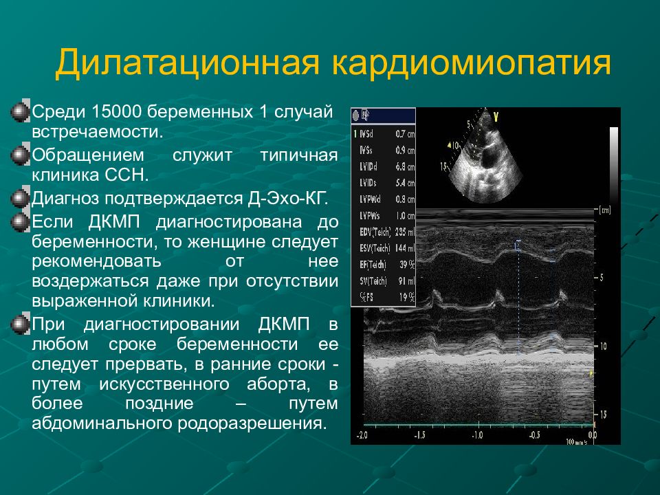 Дилатационная кардиомиопатия презентация