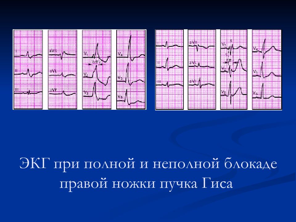 Экг неполная. Блокада левой ножки пучка Гиса (нарушение проводимости) ЭКГ. Блокада правой ножки пучка Гиса неполная ЭКГ картина. ЭКГ при блокаде правой ножки Гиса неполной. Блокада правой ножки пучка Гиса (нарушение проводимости) ЭКГ.