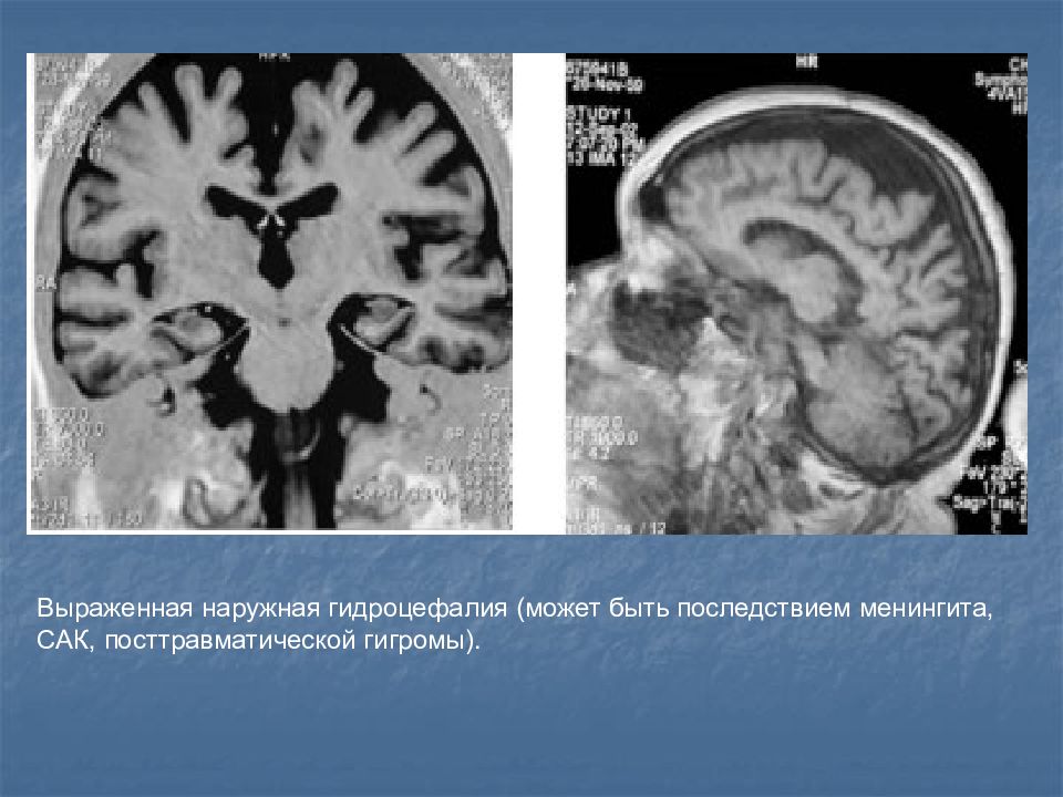 Лечение наружная гидроцефалия мозга