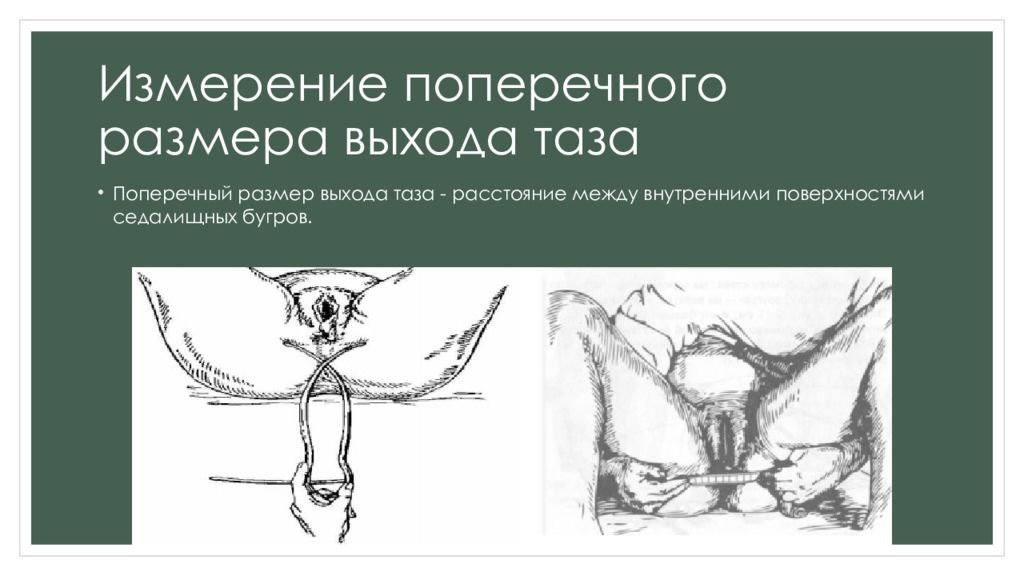 Размер выхода. Поперечный размер выхода таза. Поперечный размер. Измерение размеров выхода таза. Измерение прямого размера выхода таза.