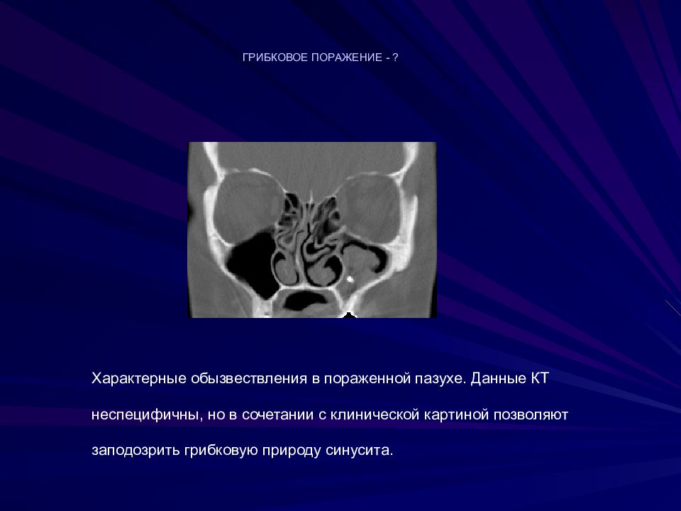Кт придаточных пазух. Кт верхнечелюстной пазухи. Кт анатомия верхнечелюстной пазухи. Мицетома верхнечелюстной пазухи на кт. Кт околоносовых пазух синусит.