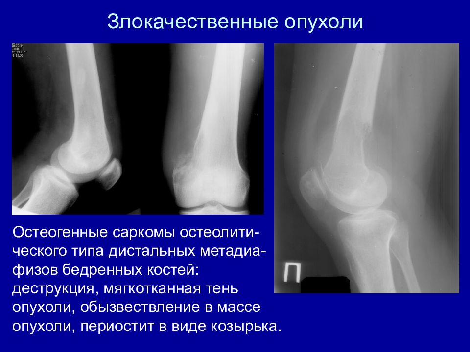 Опухоли костей презентация