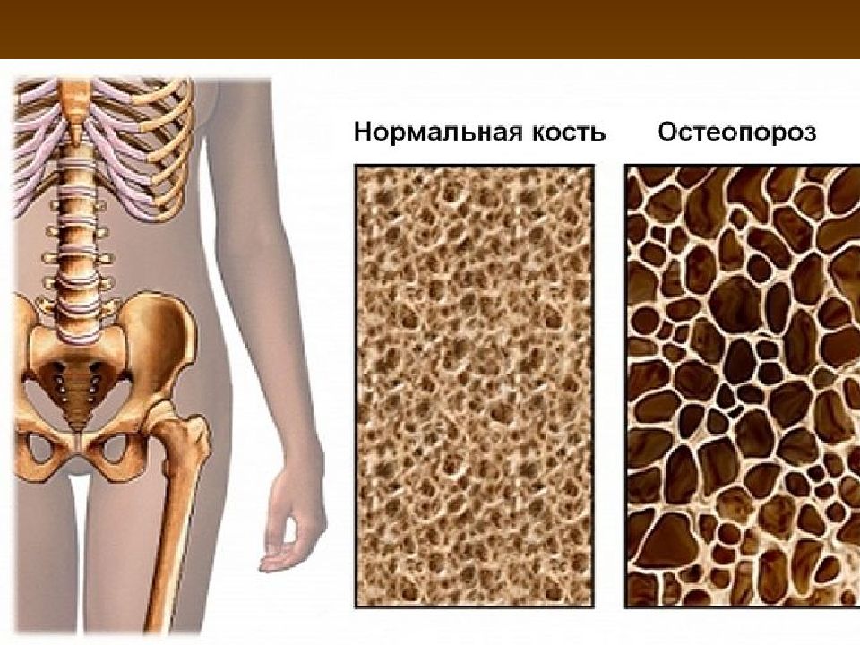 Изменение структуры кости. Нормальная кость и остеопороз. Костная ткань остеопороз. Остеопения и остеопороз. Нормальная кость и кость с остеопорозом.
