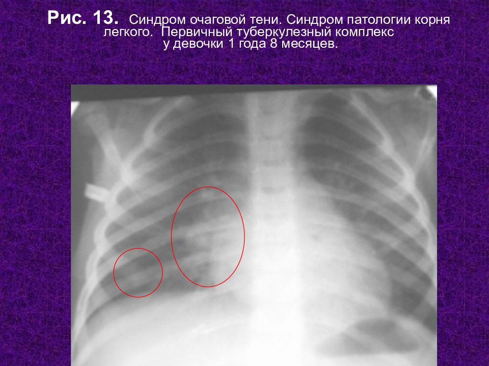 Тень в легких. Очаговая тень. Синдром очаговой тени. Очаговые тени в легких. Очаговые тени в легких на рентгене.