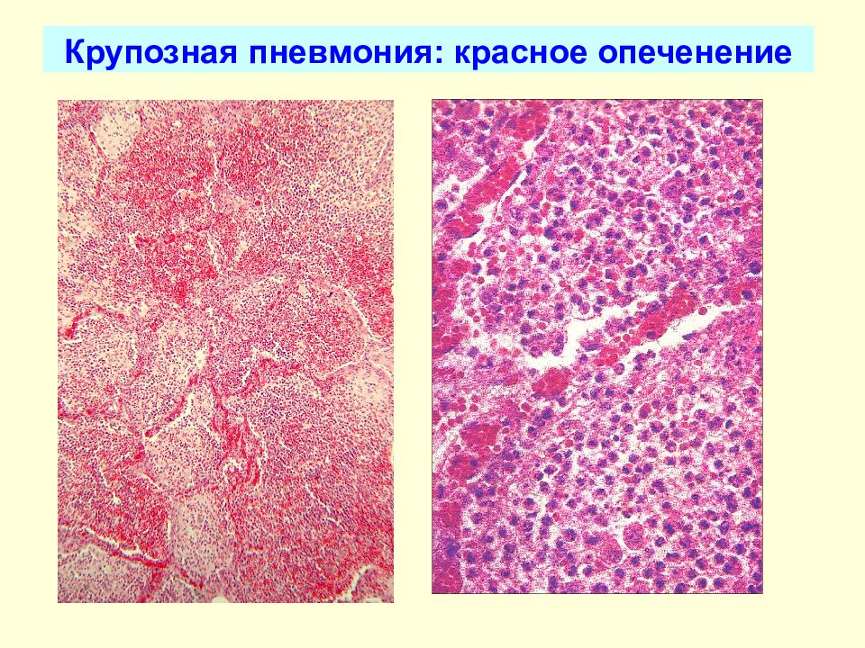 Очаговая пневмония рисунок микропрепарат