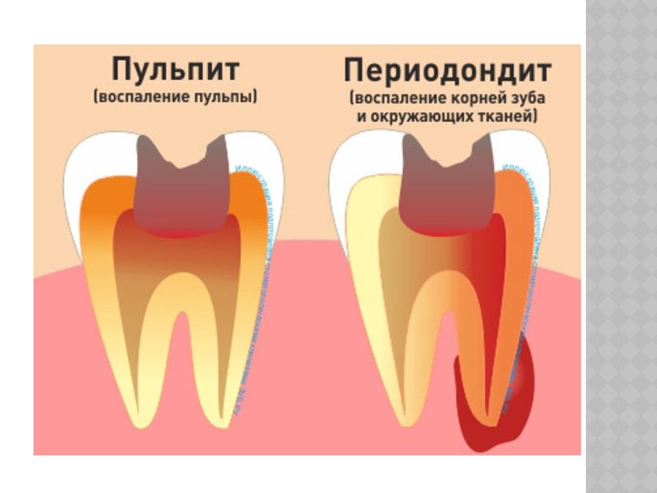 Каналы коренного зуба. Зубы кариес пульпит периодонтит.