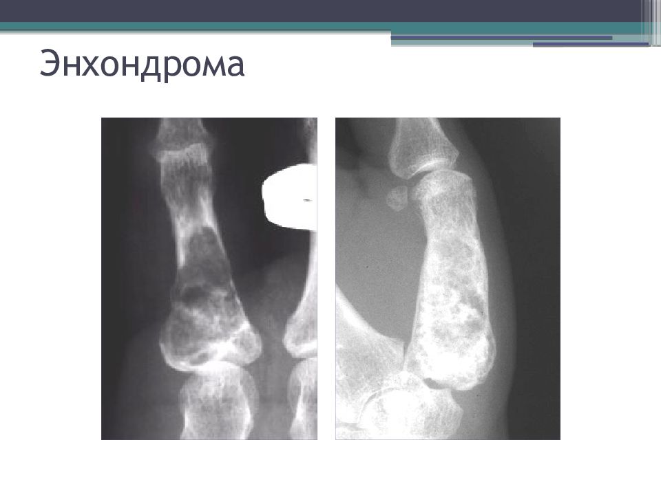 Опухоли костей презентация