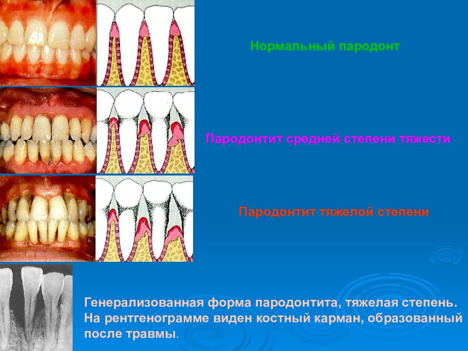 Факторы пародонта. Абсцедирующий пародонтит. Генерализованный гингивит.