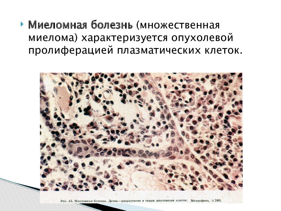 Миеломная болезнь презентация