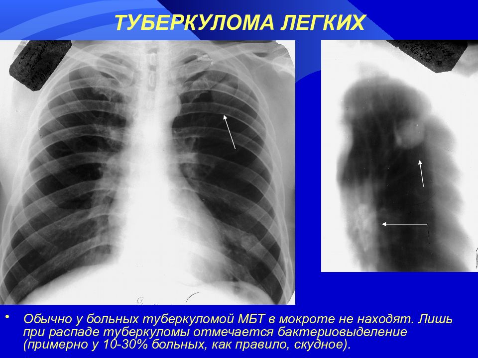 Туберкулома легких картинки