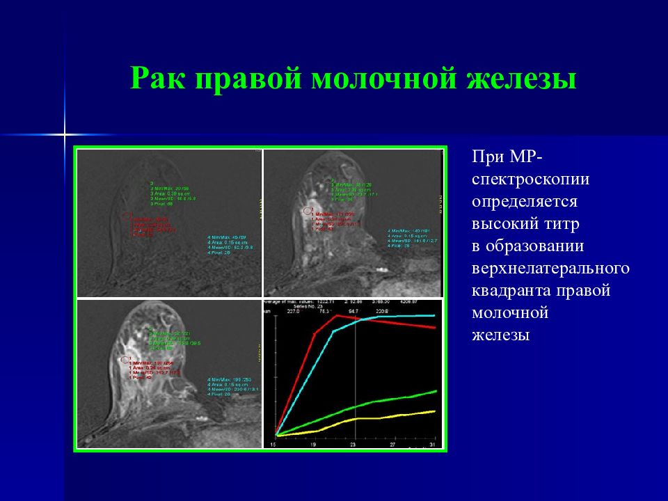 Лучевая железа. Лучевая диагностика груди. Верхнелатеральный Квадрант молочной железы. Лучевая диагностика молочных желёз. Лучевая диагностика молочных желез презентация.