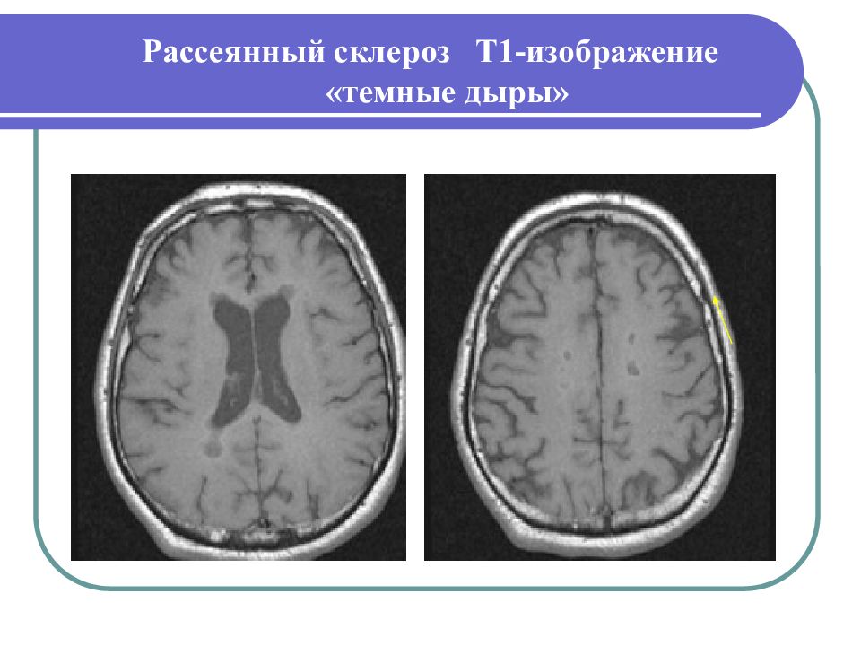 Демиелинизирующие заболевания презентация