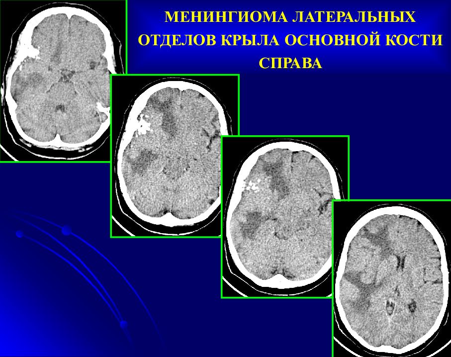 Менингиома на кт. Менингиома большого крыла клиновидной кости. Менингиома крыла клиновидной кости на кт. Менингиома малого крыла основной кости. Менингиома крыла основной кости на кт.