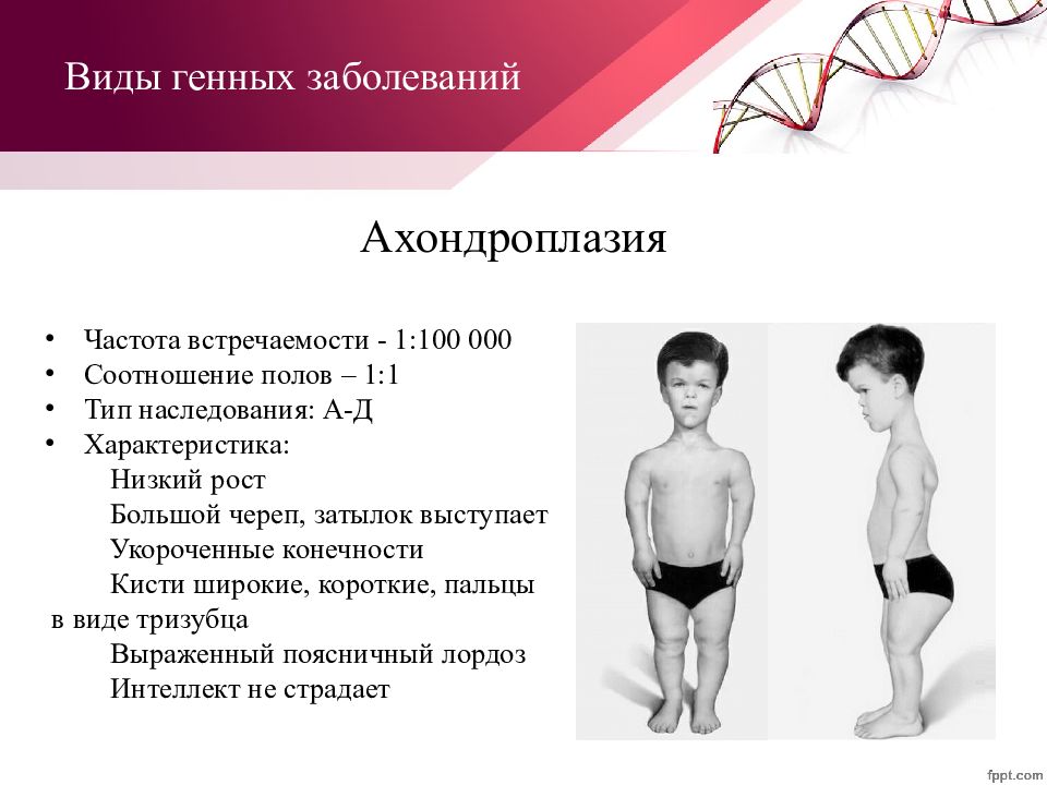 Ген заболевания. Генетические заболевания. Ахондроплазия Тип наследования. Генетическое заболевание ахондроплазия.