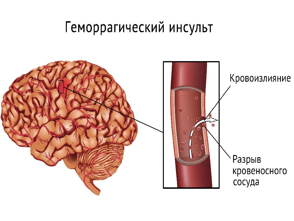 Геморрагический инсульт тесты с ответами. Геморрагический инсульт макропрепарат. Геморрагический инсульт картинки. Фармакотерапия геморрагического инсульта. Геморрагический инсульт кома.