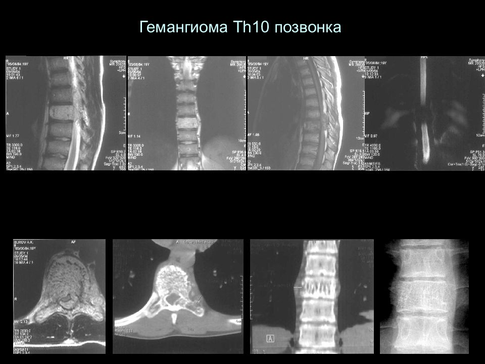 Тела th2 позвонка