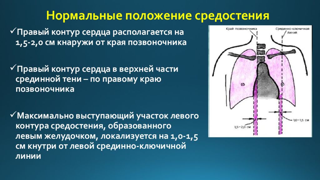 Нормальное положение. Положение средостения. Положение сердца средостение. Нормальные контуры сердца. Тень средостения срединна.