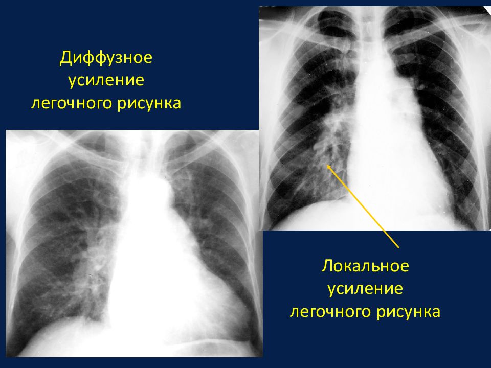 Легочный рисунок усилен в прикорневых отделах что это значит у взрослого