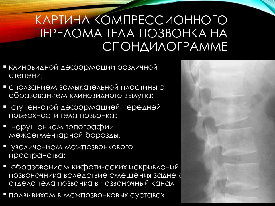 Переломы позвоночника презентация