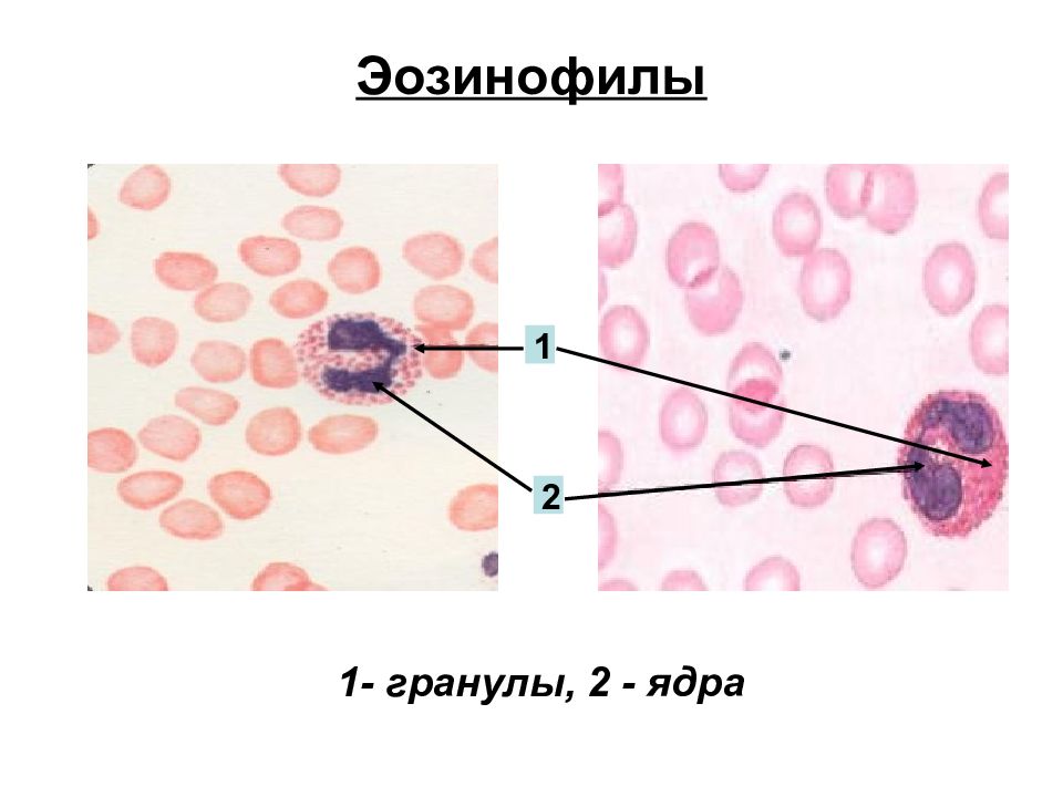 Ядро эозинофила. Эозинофилы строение гранул. Специфические гранулы эозинофилов. Эозинофилы состав гранул. Химический состав гранул эозинофилы.