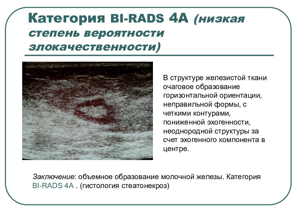 Образование повышенной эхогенности в молочной железе. Гетерогенная структурное образование молочной железы. Образования в молочной железе с четкими контурами заключение. Гипоэхогенное образование в молочной железе с неровными контурами.