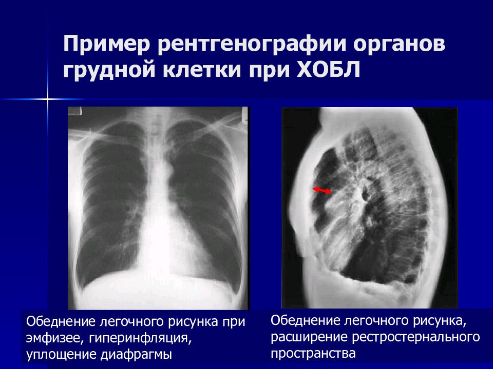 Лучевая диагностика хобл презентация