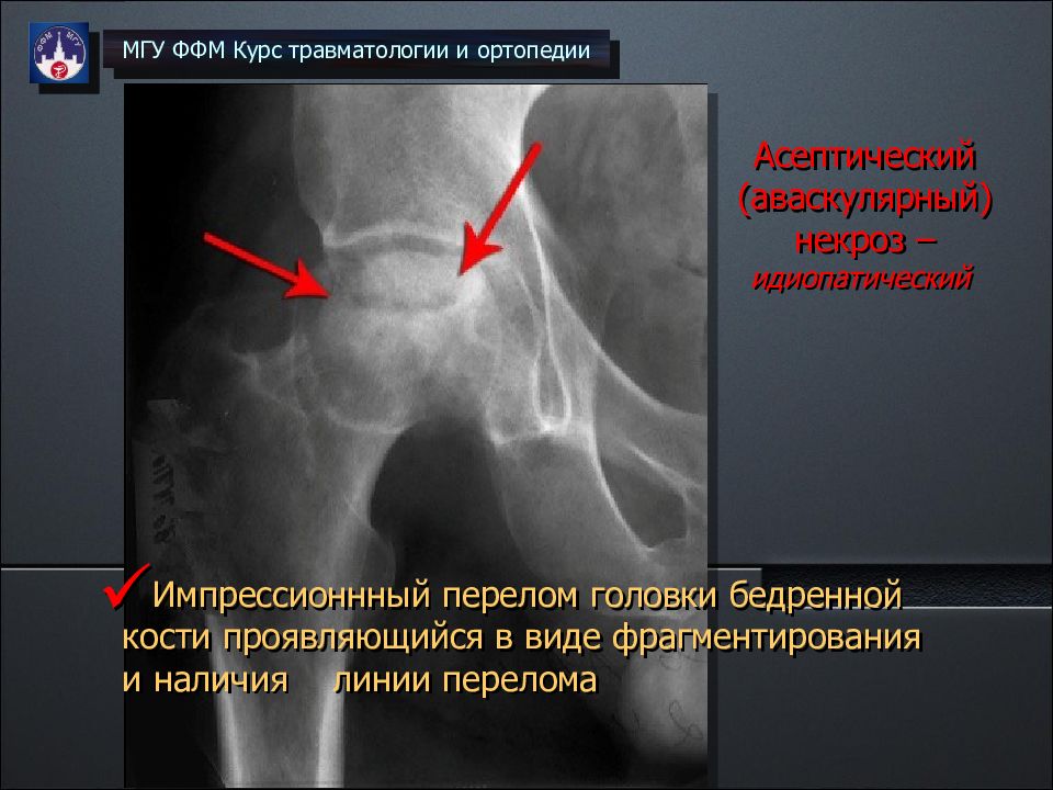 Асептический коксартроз. Субхондральный перелом головки бедренной кости. Перелом головки бедренной кости рентгенограмма. Деструкция головки бедренной кости рентген. Импрессионный перелом головки бедренной кости асептический некроз.