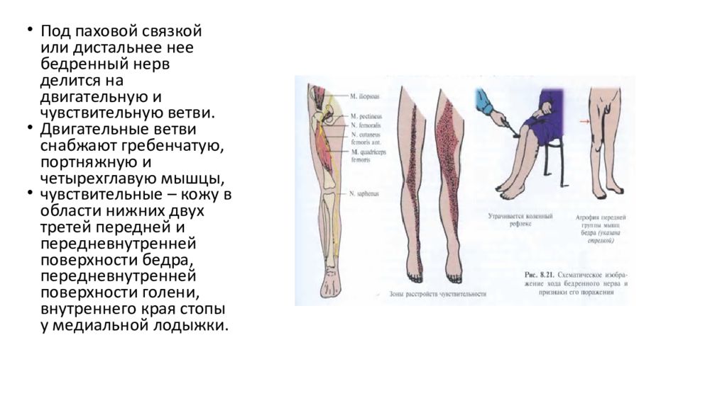 Невропатия наружная бедра