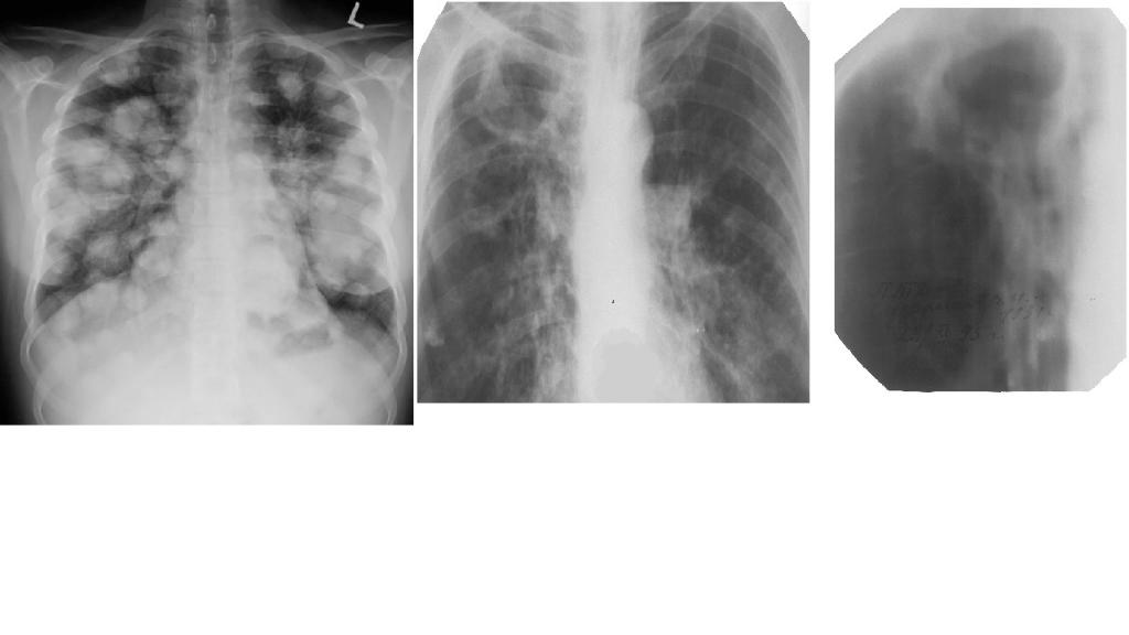 Рак легких 4. ОАК туберкулез и пневмония. Разница пневмонии и туберкулеза на рентгене. Рентген при бронхите и туберкулезе. Туберкулёз на снимке и пневмония.