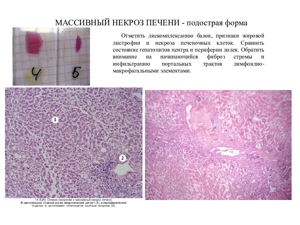 Некроз печени симптомы