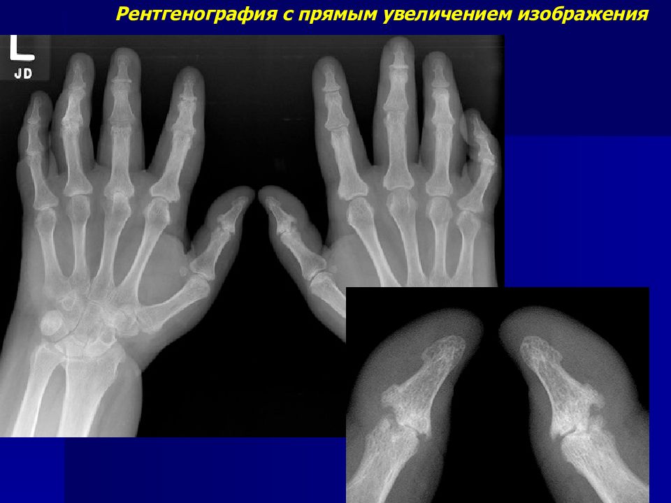 Рентгенография с прямым увеличением изображения применяется