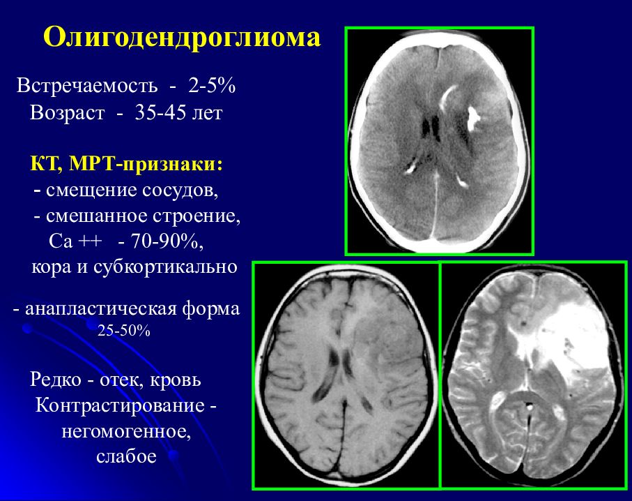 Мрт признаки. Субкортикально мрт. Рентгенодиагностика опухолей головного мозга. Олигодендроглиома головного. Новообразования головного мозга диагностика кт.