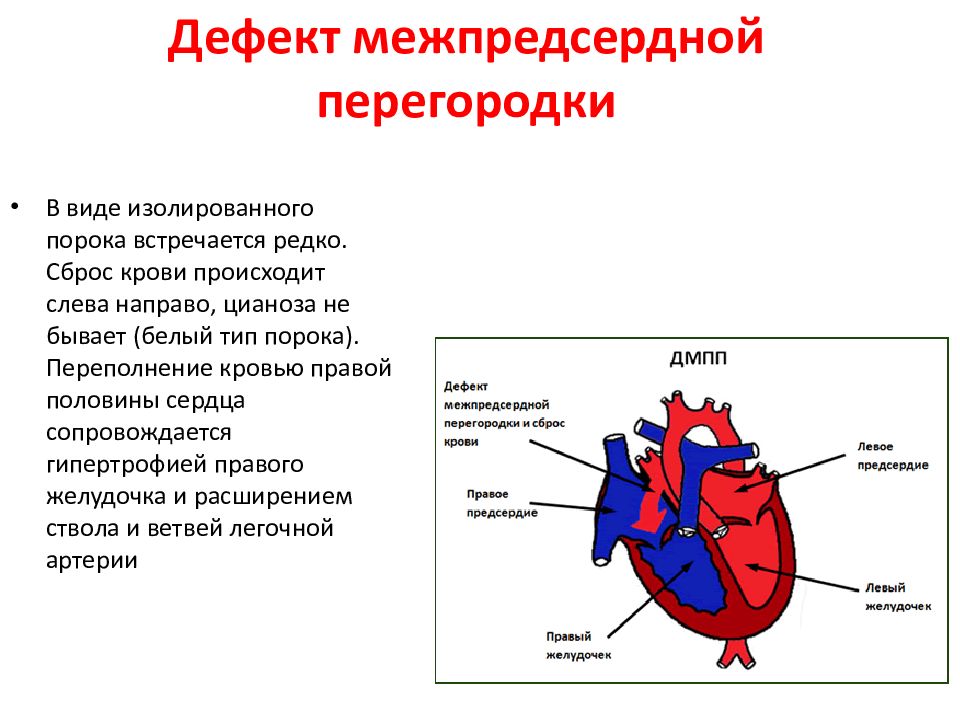 Операция межпредсердной перегородки. Межпредсердная перегородка дефект. Дефект межпредсердной перегородки классификация. Дефект межпредсердной перегородки гемодинамика схема. Пролапс межпредсердной перегородки.