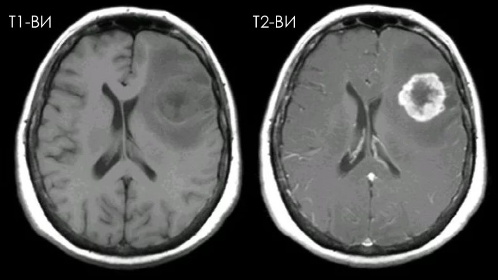 T 1 ru. T1 t2 мрт. T2 Flair мрт. Т1 ви и т2 ви на мрт. Т2 взвешенное изображение мрт.