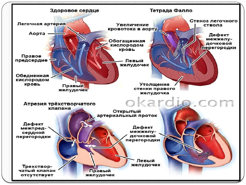 Трикуспидальный клапан сердца. Врожденный порок сердца межжелудочковой перегородки. Врожденный порок сердца транспозиция магистральных сосудов. Дефект межжелудочковой перегородки гемодинамика.