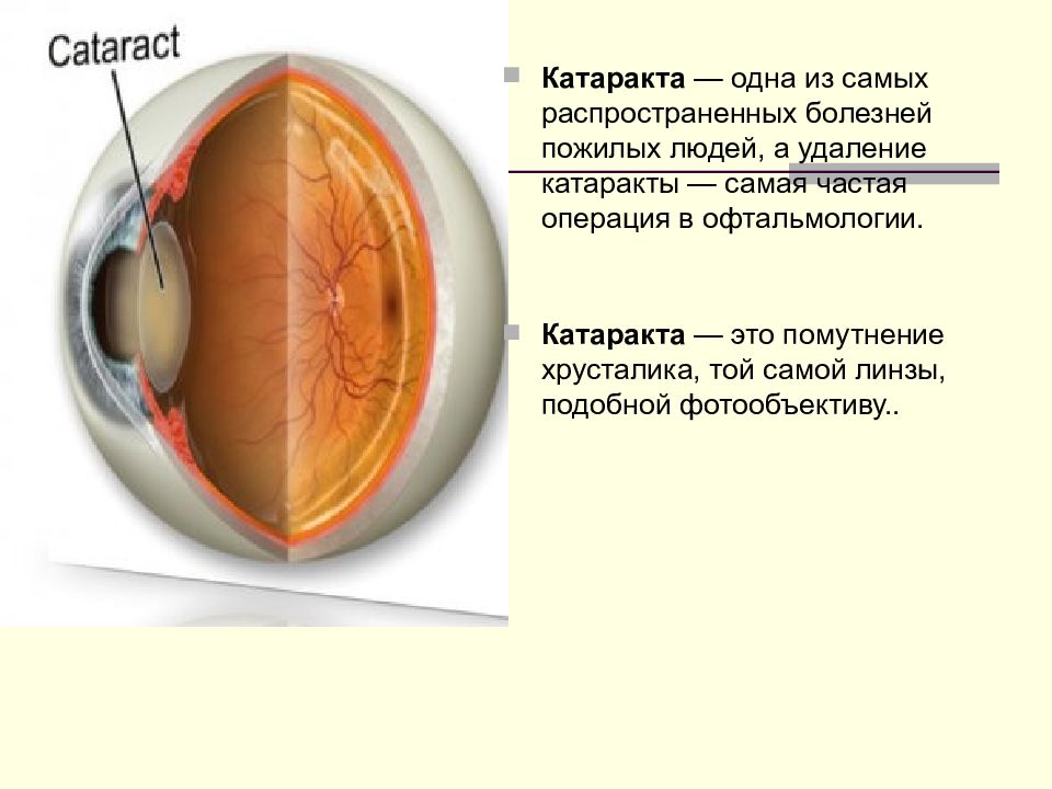 Катаракта картинки биология